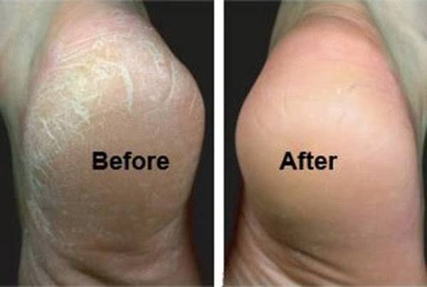 Home Made Remedies For Cracked Heels